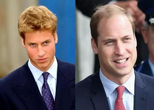 甲状腺癌专家谈脱发增加癌症风险