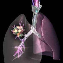 诱发肺癌的病因是什么