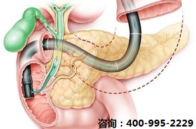 石家庄肿瘤医院肿瘤介入治疗